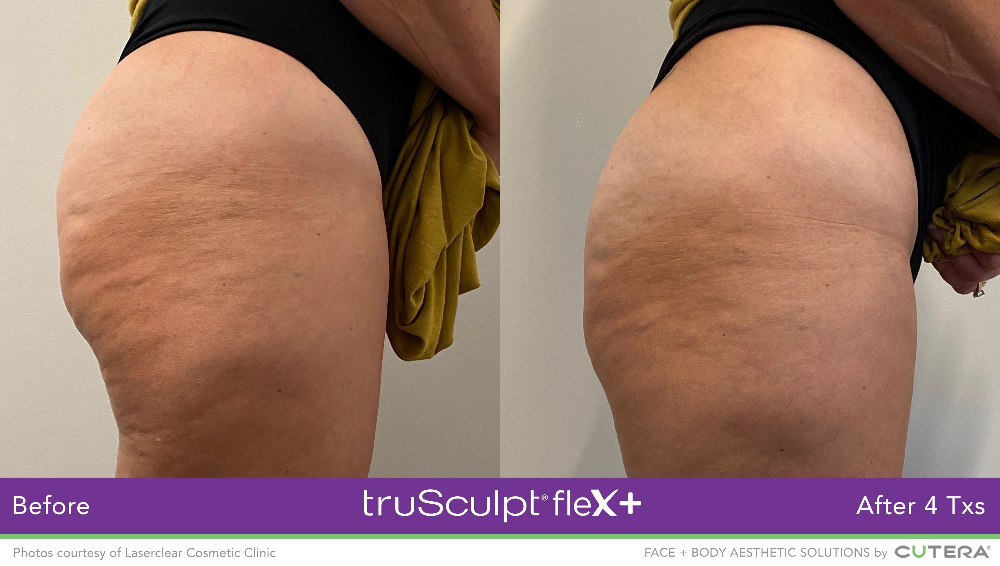 truSculpt Flex Results Image -6398c91d56f5b